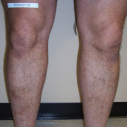 Bilateral VNUS Closures and subsequent Sclerotherapy (Injections) after 1576302