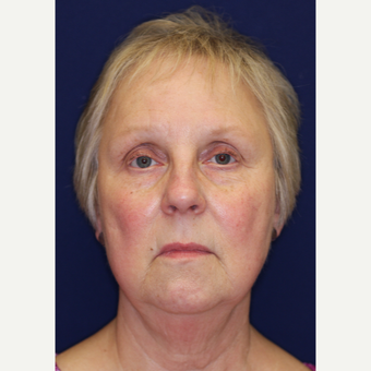 55-64 year old woman treated with Facelift before 3070821