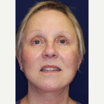 55-64 year old woman treated with Facelift after 3070821