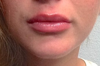 18-24 year old woman treated for Lip Augmentation after 1535436