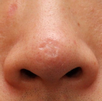 Laser and Filler for Indented Scarring 1357678