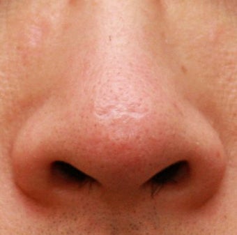 Laser and Filler for Indented Scarring 1357678