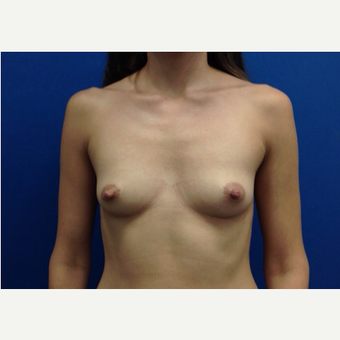 Breast Fat Transfer before 2791109