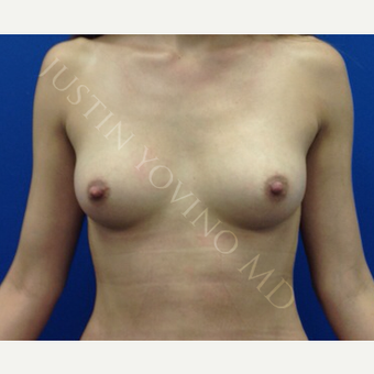 Breast Fat Transfer after 2791109