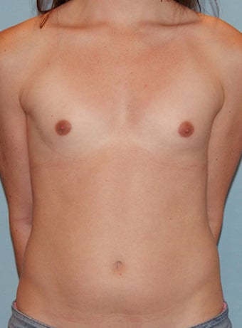 Transgender Breast Augmentation before 673498