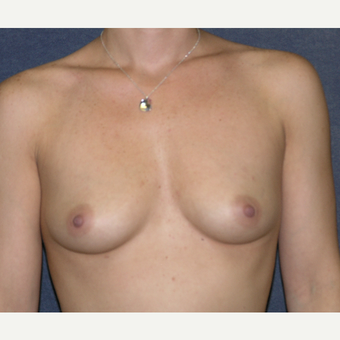 35-44 year old woman treated with Breast Augmentation before 3455613