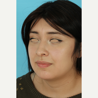 25-34 year old woman treated with Rhinoplasty before 3691273