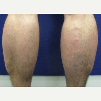 25-34 year old man treated with Calf Implant 1880343