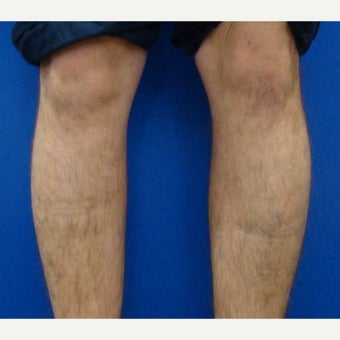25-34 year old man treated with Calf Implant before 1880343