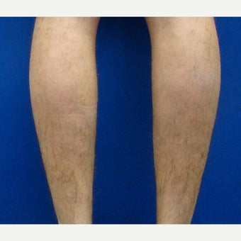25-34 year old man treated with Calf Implant 1880343