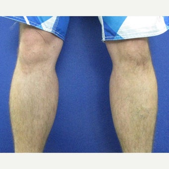 25-34 year old man treated with Calf Implant after 1880343