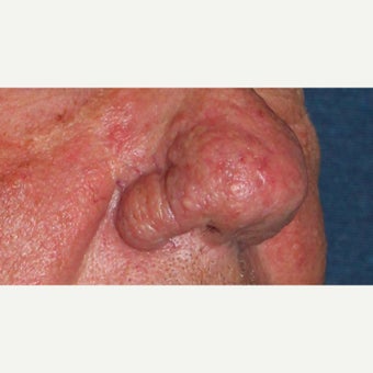61 year old man treated with CO2 Laser for rhinophyma 1783457