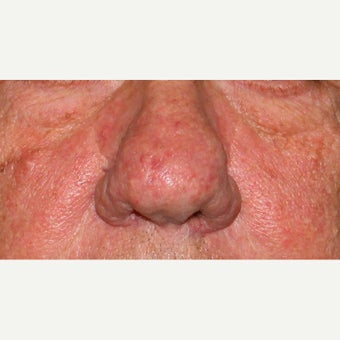 61 year old man treated with CO2 Laser for rhinophyma before 1783457