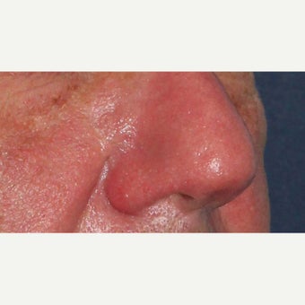 61 year old man treated with CO2 Laser for rhinophyma 1783457
