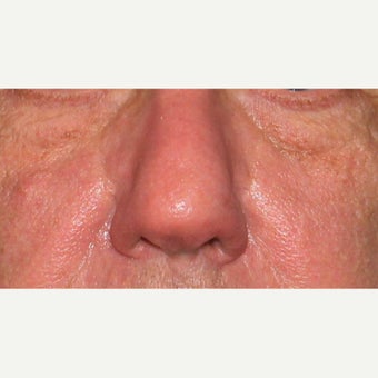 61 year old man treated with CO2 Laser for rhinophyma after 1783457