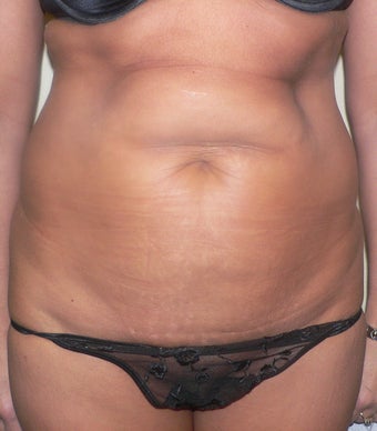 47 year old woman has Tummy Tuck before 990602