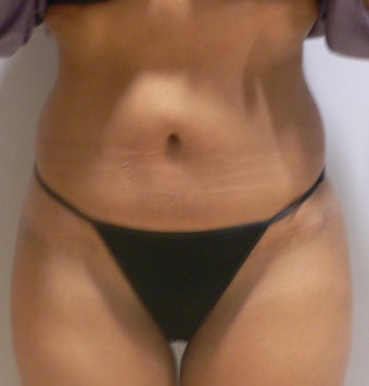 47 year old woman has Tummy Tuck after 990602
