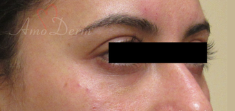 35-44 year old woman treated with Restylane after 3835938