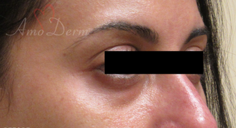 35-44 year old woman treated with Restylane before 3835938