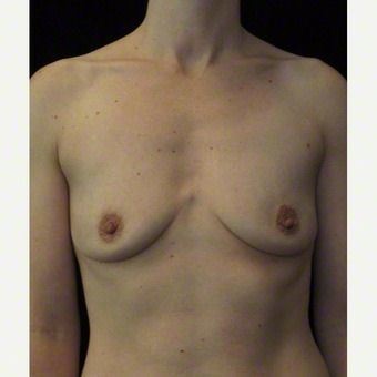 36 year old woman treated with Breast Augmentation before 3103607
