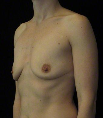 36 year old woman treated with Breast Augmentation 3103607
