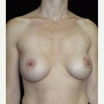 36 year old woman treated with Breast Augmentation after 3103607