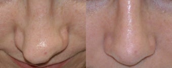 Revision Rhinoplasty before 548874