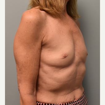 55-64 year old woman treated with Sientra Breast Implants before 3304999