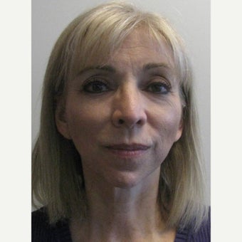 56 year old female TMJ, Orthognathic, and Facelift Surgery before 2181897