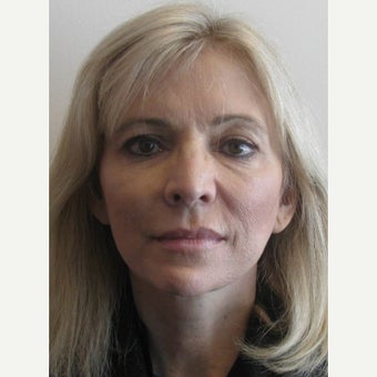 56 year old female TMJ, Orthognathic, and Facelift Surgery after 2181897