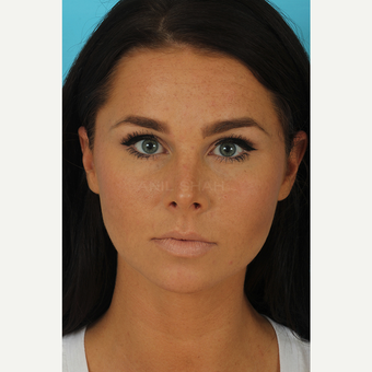 25-34 year old woman treated with Rhinoplasty after 3629314