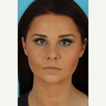 25-34 year old woman treated with Rhinoplasty before 3629314
