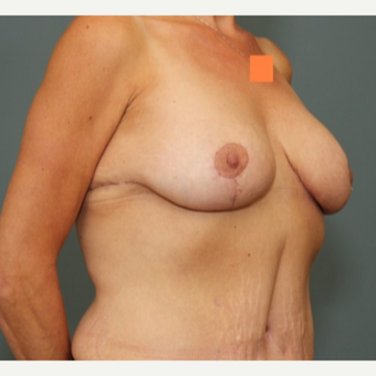 35-44 year old woman requesting Breast Lift after 3346488