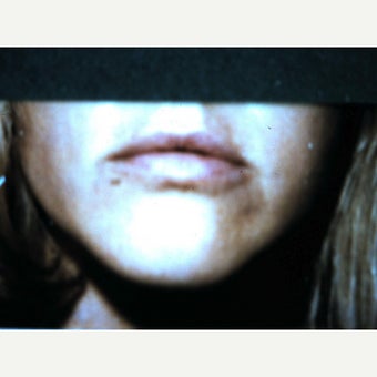 18-24 year old woman treated with Lip Surgery before 1622536