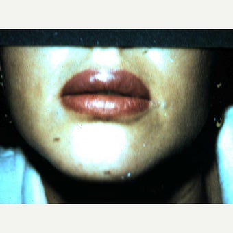 18-24 year old woman treated with Lip Surgery after 1622536