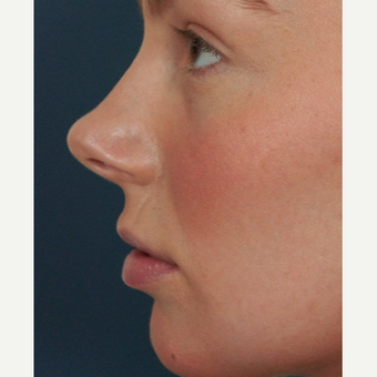 18-24 year old woman treated with Lip Augmentation before 3244982