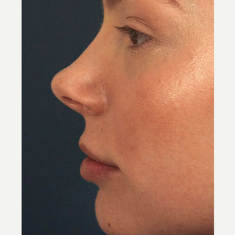 18-24 year old woman treated with Lip Augmentation after 3244982