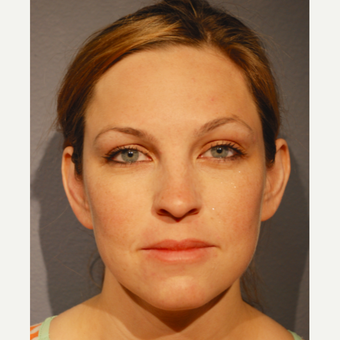25-34 year old woman treated with Ear Surgery before 3363586