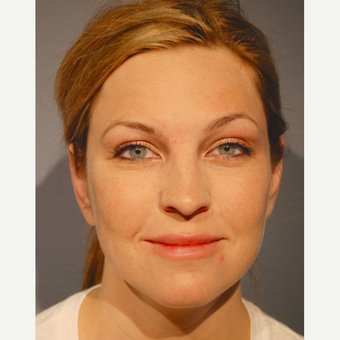 25-34 year old woman treated with Ear Surgery after 3363586