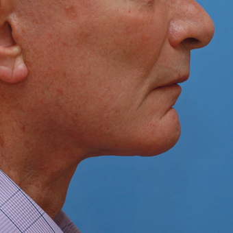Gentleman in his high 70s almost 3 years after necklift after 3618527