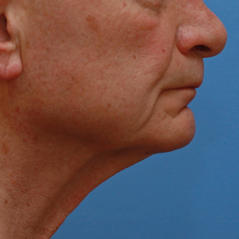 Gentleman in his high 70s almost 3 years after necklift before 3618527