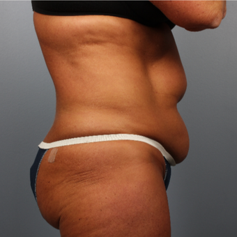 45-54 year old woman treated with CoolSculpting before 3507407