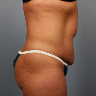 45-54 year old woman treated with CoolSculpting after 3507407