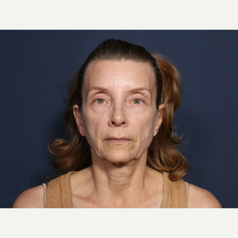 55-64 year old woman treated with Neck Lift (view 1 of 2) before 3226120