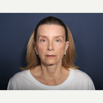 55-64 year old woman treated with Neck Lift (view 1 of 2) after 3226120