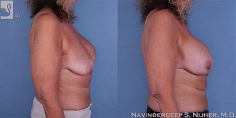 45-54 year old woman treated with Breast Implant Revision after 3767647