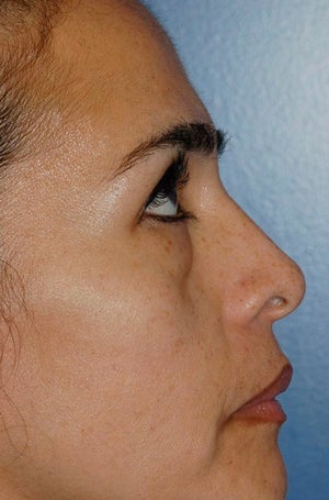 Lower lid blepharoplasty with fat grafting before 875999