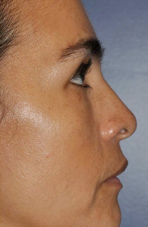 Lower lid blepharoplasty with fat grafting after 875999