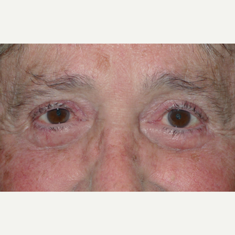 65-74 year old man treated with Eye Bags Treatment after 2721702