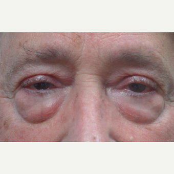 65-74 year old man treated with Eye Bags Treatment before 2721702